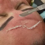 How Much Does Professional Dermaplaning Actually Cost?