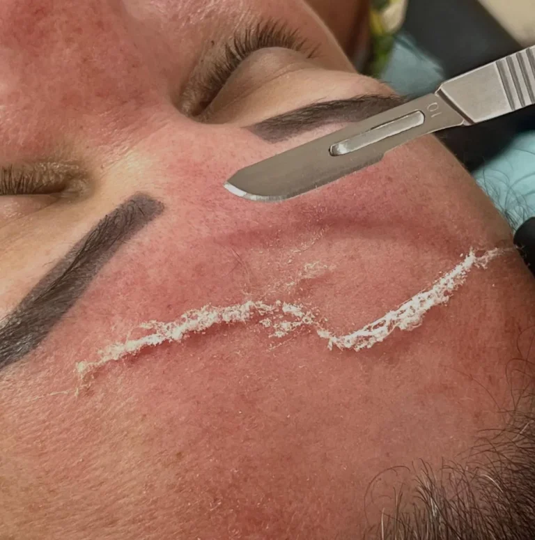 How Much Does Professional Dermaplaning Actually Cost?