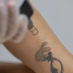 Is it painful to get a tattoo removed?