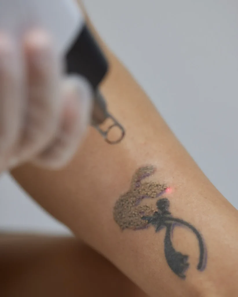 Is it painful to get a tattoo removed?